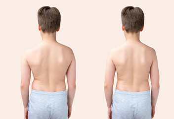 Child's back showing spinal curvature comparison, scoliosis pain, kyphosis, before and after, orthopedic treatment or physical therapy, Posture correction and spinal health