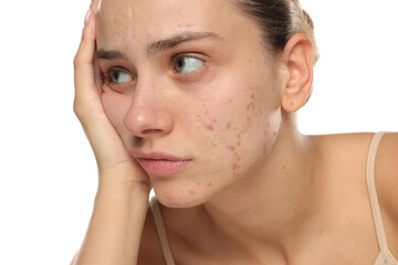 Studio shot of young woman with acne resting face on hand, looking bored and sad, skincare concept.