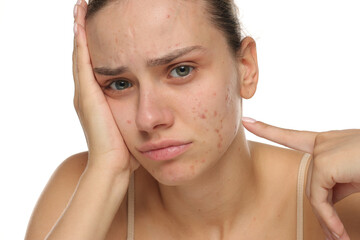 Studio shot of young woman with acne pointing at pimples, showing frustration and concern, skincare concept
