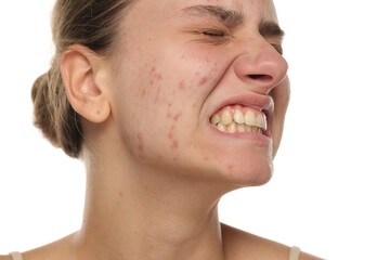 Studio shot of young woman with acne-prone skin, showing emotional distress, on white background