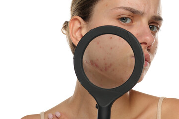 Studio shot of young woman examining acne with magnifying glass, isolated on white background.