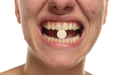 Close-up of young woman with acne holding pill between teeth, studio shot on white background.