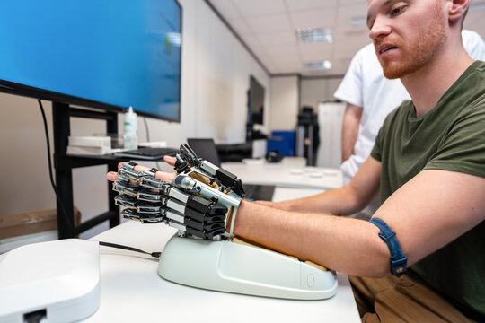 Patient testing robotic hand prosthesis controlled by muscle