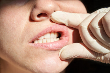 Close-up of caucasian female adult during dental exam with gloves inspecting teeth and lips.