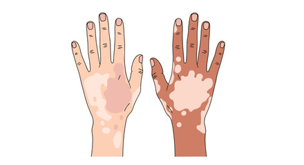 Obraz premium Skin condition with patches of light or dark skin