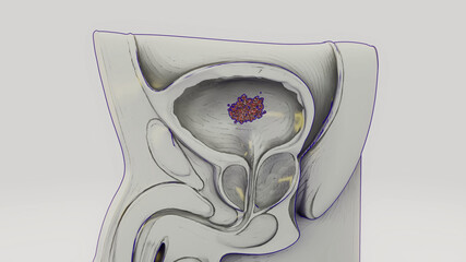 Conceptual 3D illustration of a bladder cancer