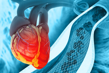 Human heart angioplasty on scientific background. 3d illustration
