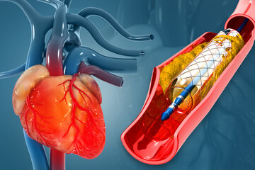 Stent angioplasty on scientific background. 3d illustration