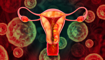 Uterus or uterine cancer. Medical concept as cancerous cells spreading in a female reproductive system. 3d illustration
