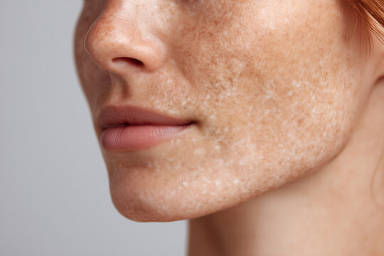 Macro photo of skin affected by tinea versicolor with uneven pigment