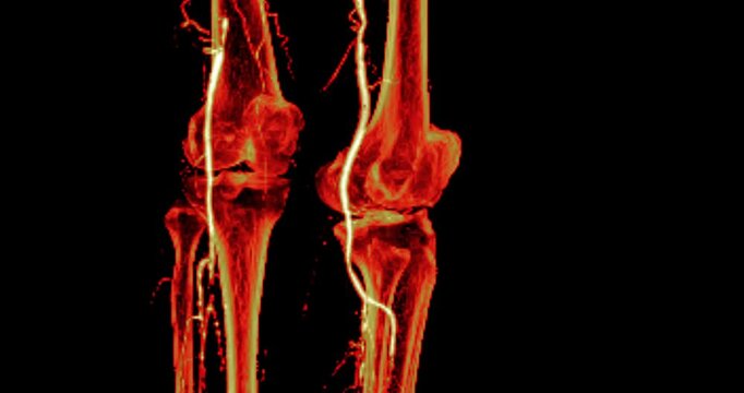 CTA femoral artery run off showing  femoral artery at knee area for diagnostic  Acute or Chronic Peripheral Arterial Disease.