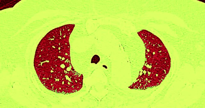 CT scan of Chest axial view for diagnostic Pulmonary embolism (PE) , lung cancer and covid-19. 