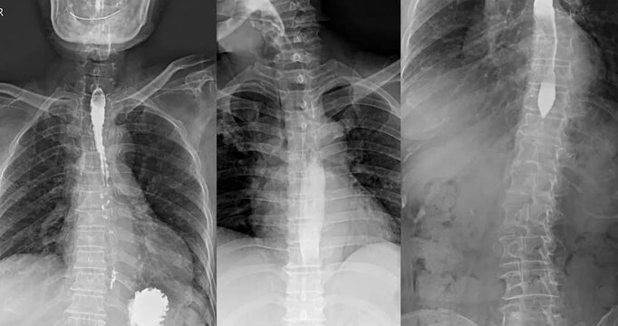 Fluoroscopic footage of a barium swallow test showing real-time esophageal function, used to assess dysphagia, GERD, and structural abnormalities.