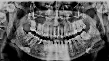 Obraz premium Panoramic dental X-ray showing the full structure of human teeth with multiple damaged teeth, decay, fillings, and dental restorations, root canal treatment. Suitable for dental education, healthcare