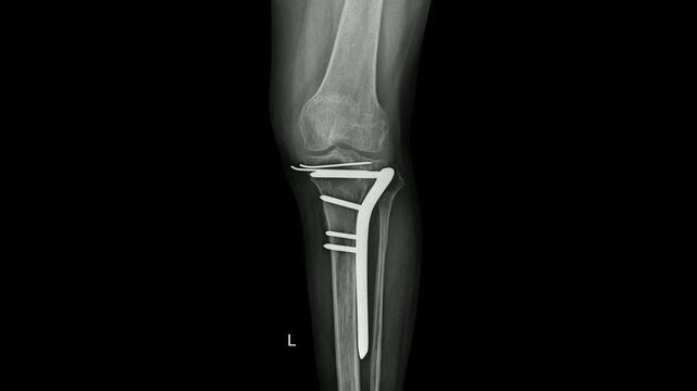 Post-operative X-ray showing internal fixation of a proximal tibial fracture with plate and screws