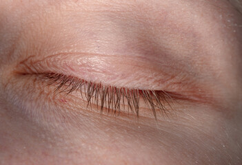 Glued eyelashes close up, demodex disease, closed eye