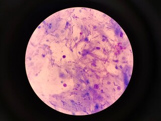 Fungal Spores in Urogenital Smear, Candidiasis Diagnosis Concept