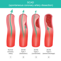 Types of Spontaneous Coronary Artery Dissection (SCAD). Illustrates.