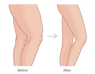 Legs before and after weight loss. Slimming of legs vector illustration.
