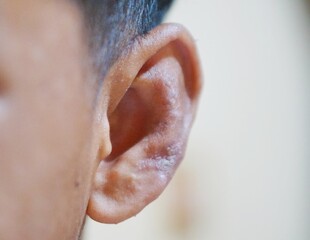 Dermatitis or skin conditions affecting the outer ear appear as red patches, caused by fungal...
