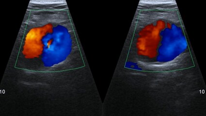 Ultrasound scan of a patient's abdominal aorta