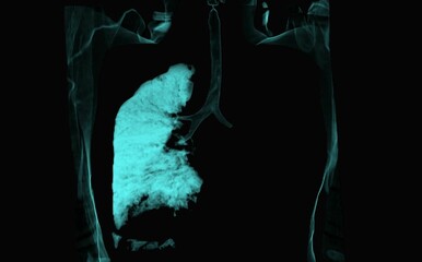 Colored 3d chest ct scan showing left lung carcinoma, no air in left lung  