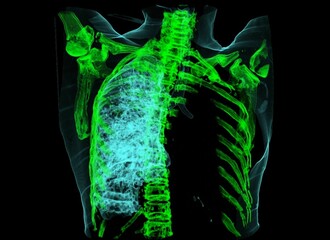 Colored 3d chest ct scan showing left lung carcinoma, no air in left lung  