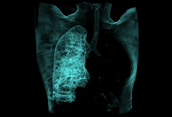 Colored 3d chest ct scan showing left lung carcinoma, no air in left lung  