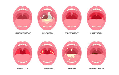 Oropharyngeal infections poster