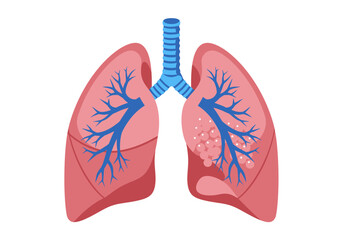 Human Lungs with Bronchial Tree and Pulmonary Nodules Illustration.
