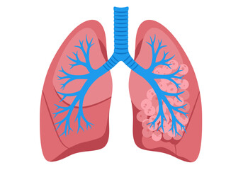 Simplified Anatomical Illustration of Human Lungs with Blue Airways and Alveoli.