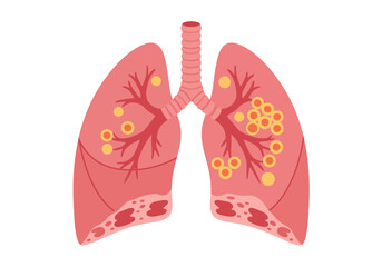 Diseased Lungs Illustration with Tumors and Damaged Tissue Medical Concept.