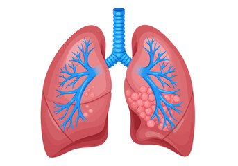 Detailed Illustration of Human Lungs with Bronchial Tree and Alveoli.