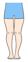XO脚、複合型脚変形、女性の下肢