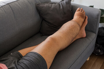 Close Up Of Unrecognized Male With Severely Swollen Leg Resting On Sofa