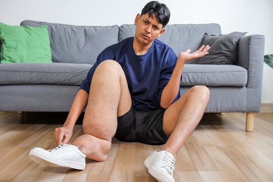 Young Asian Man With Lymphatic Filariasis Shrugging Hand While