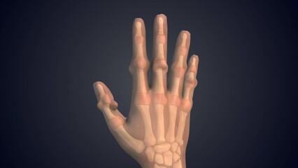 Swollen Synovial Cavity With Inflammatory Tissue