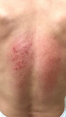 Fototapeta premium close up of red Bruise on a woman skin.