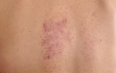 Fototapeta premium Close up red Bruise on the skin.