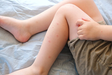 Child scratch body has sensitive itchy skin. Bodily rash. Kid allergy closeup. Little baby scratches eruption. Irritation, hive. Pruritus. Mosquito insect bite. Red from sunburn, Seborrheic Dermatitis