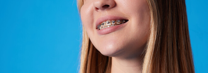 Woman is showing her teeth with braces, close-up. Smile with braces, side view. Orthodontic treatment, banner with copy space for text.