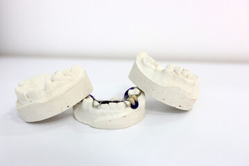 Mandibular teeth cast. Obtaining a cast of the dental arch for the purpose of manufacturing...