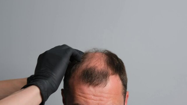 A close-up of a man's head with visible hair loss and thinning on the crown, as a person wearing black gloves examines the scalp. Concept of baldness treatment or hair restoration.