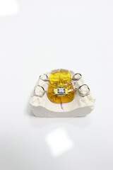Mandibular teeth cast. Obtaining a cast of the dental arch for the purpose of manufacturing...