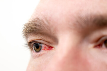 Close up side view of male eye with redness and irritation, symbolizing eye strain, visual fatigue...