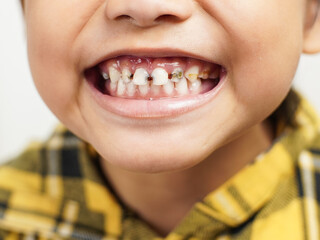 Close-up of a child showing severe tooth decay and plaque on upper teeth. Used for dental care...