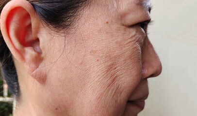 close up the flabbiness and wrinkle, swelling and ptosis beside the eyelid, dark spots and...