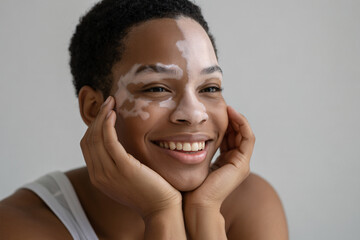 Smiling Black woman with vitiligo resting her hands near her face. Embracing beauty in diversity and skin difference