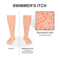 Swimmer's itch by microscopaic parasites called schistosomes
