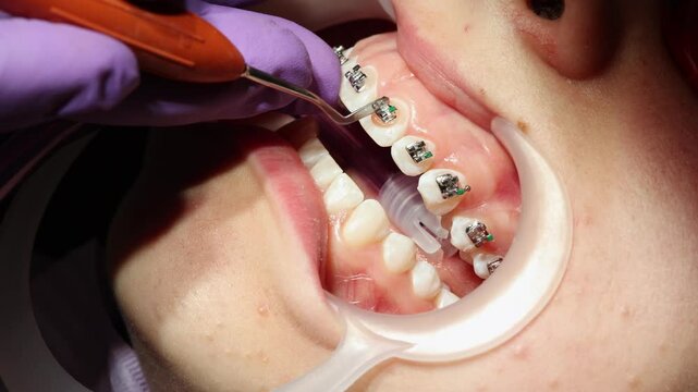 Orthodontist Applying Braces on Patient's Teeth, Close-up video of an orthodontist installing braces on a young patient's teeth during a dental procedure with professional tools.  